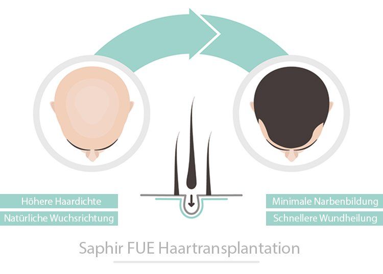 Saphir-FUE-Methode-Haartransplantation