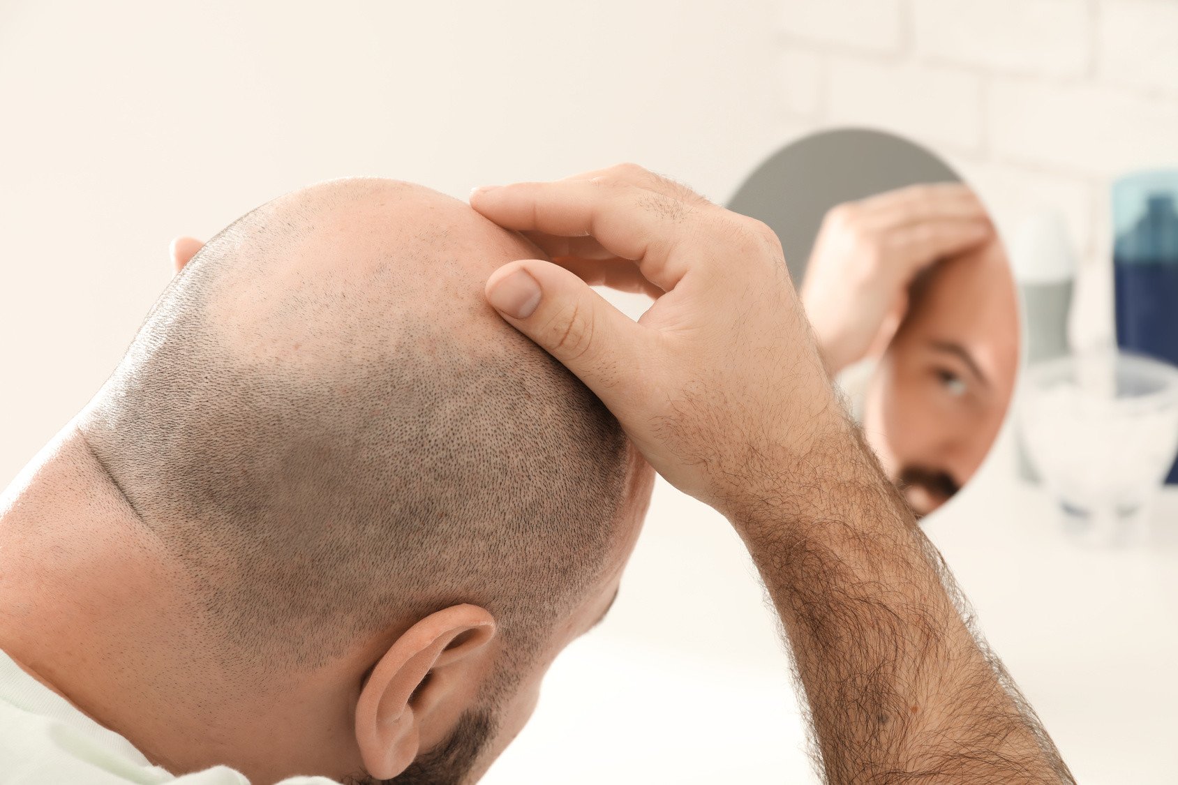 Totaler Haarausfall – Alopecia Universalis