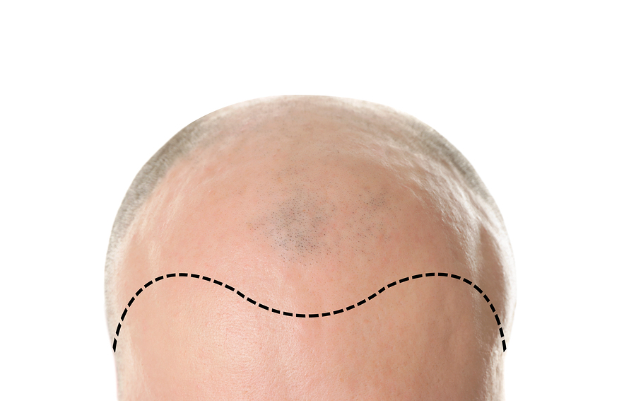 Haarpigmentierung