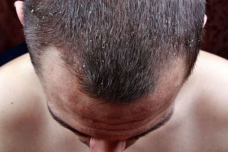 Haarausfall durch schuppige Kopfhaut