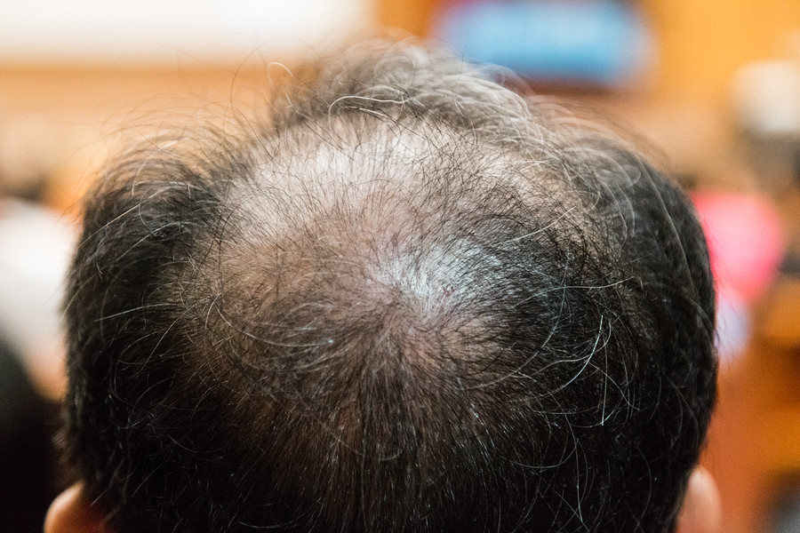 Die Reiztherapie bei kreisrundem Haarausfall ist effektiv