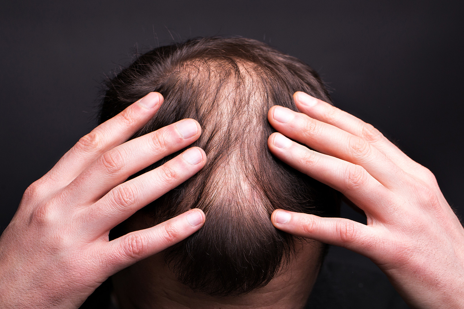 Haarausfall durch Folliculitis decalvans Ist der Haarschwund behandelbar