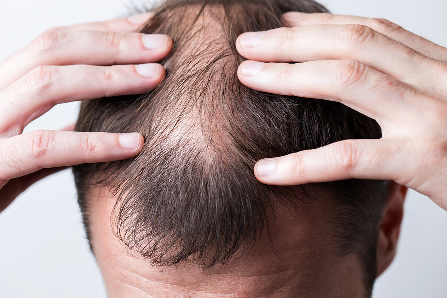 Alopecia congenita - eine seltene Form von Haarausfall