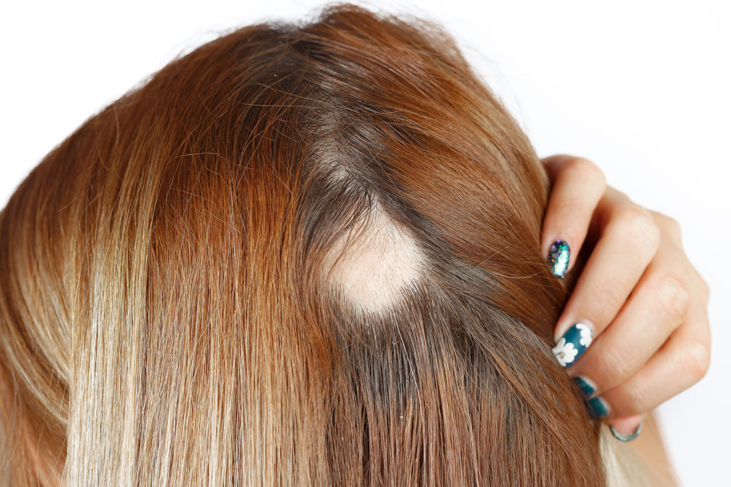 Geheimwaffe gegen kreisrunden Haarausfall