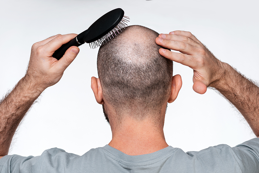 Haartransplantation bei Tonsur