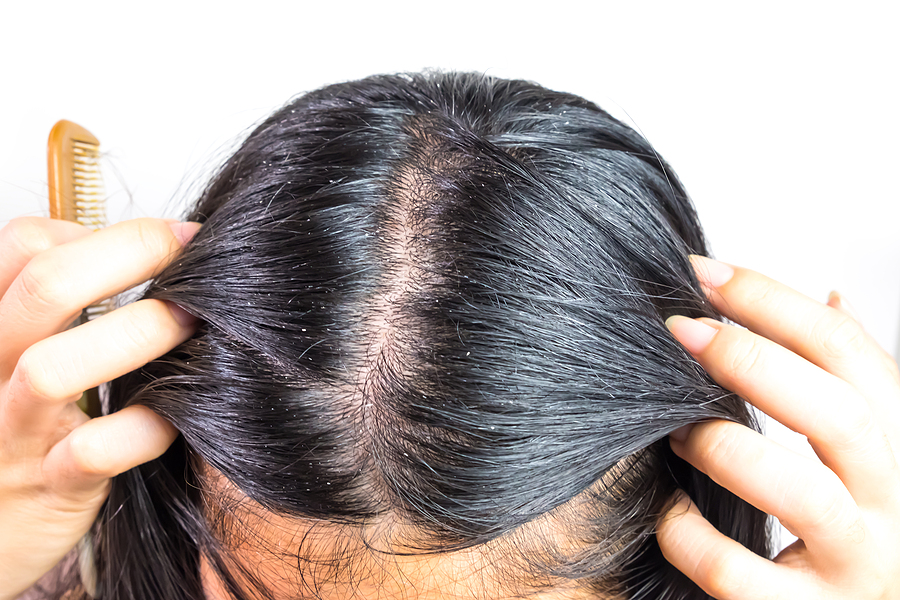 Seborrhoische Dermatitis mit Haarausfall